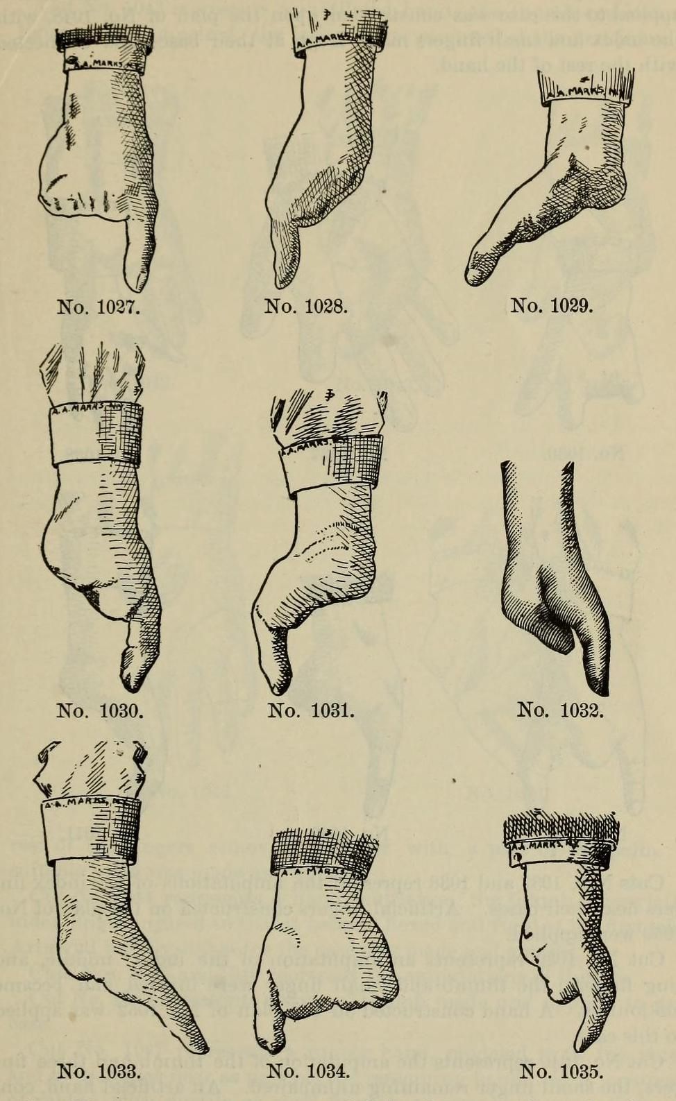 Vintage medical illustration of nine deformed feet and lower legs, each encased in a stocking and labeled with a number.