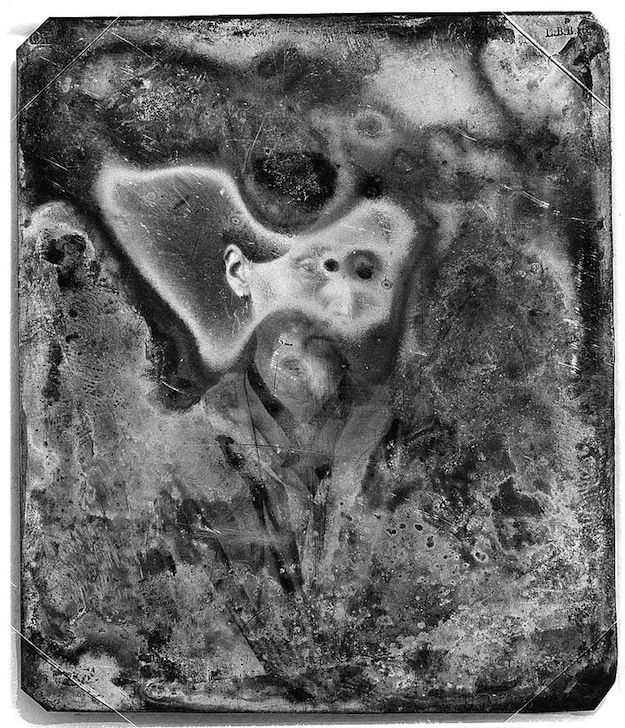 A close-up black and white photograph of a person with a grotesquely large ear. The image is heavily textured and appears to be an antique daguerreotype.