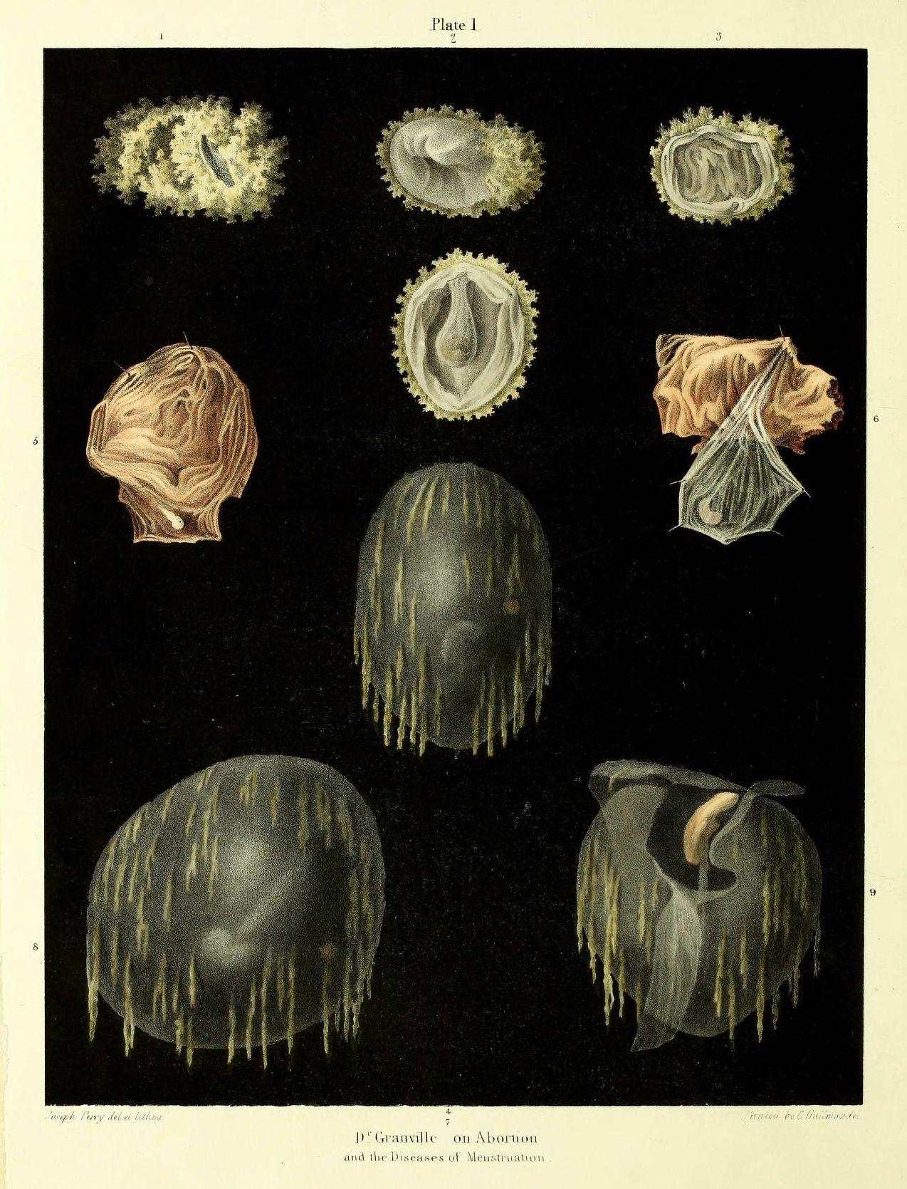 A vintage medical illustration titled 'Plate 1' depicting nine detailed cross-sections of a uterus, likely related to abortion and menstrual diseases.