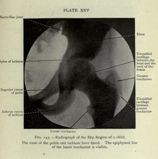 Vintage radiographic image of the hip region of a child, labeled with anatomical terms.