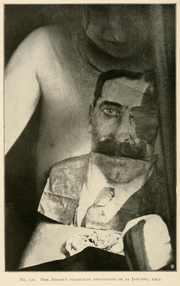 A black and white photograph of a man with severe burns on his face and arms, taken in 1913.