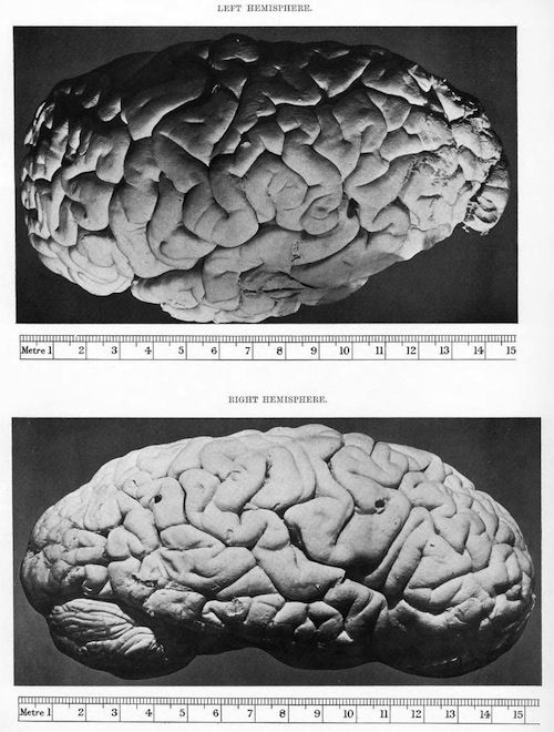 Two black and white photographs of human brain hemispheres, labeled "LEFT HEMISPHERE" and "RIGHT HEMISPHERE", with a metric scale beneath each.