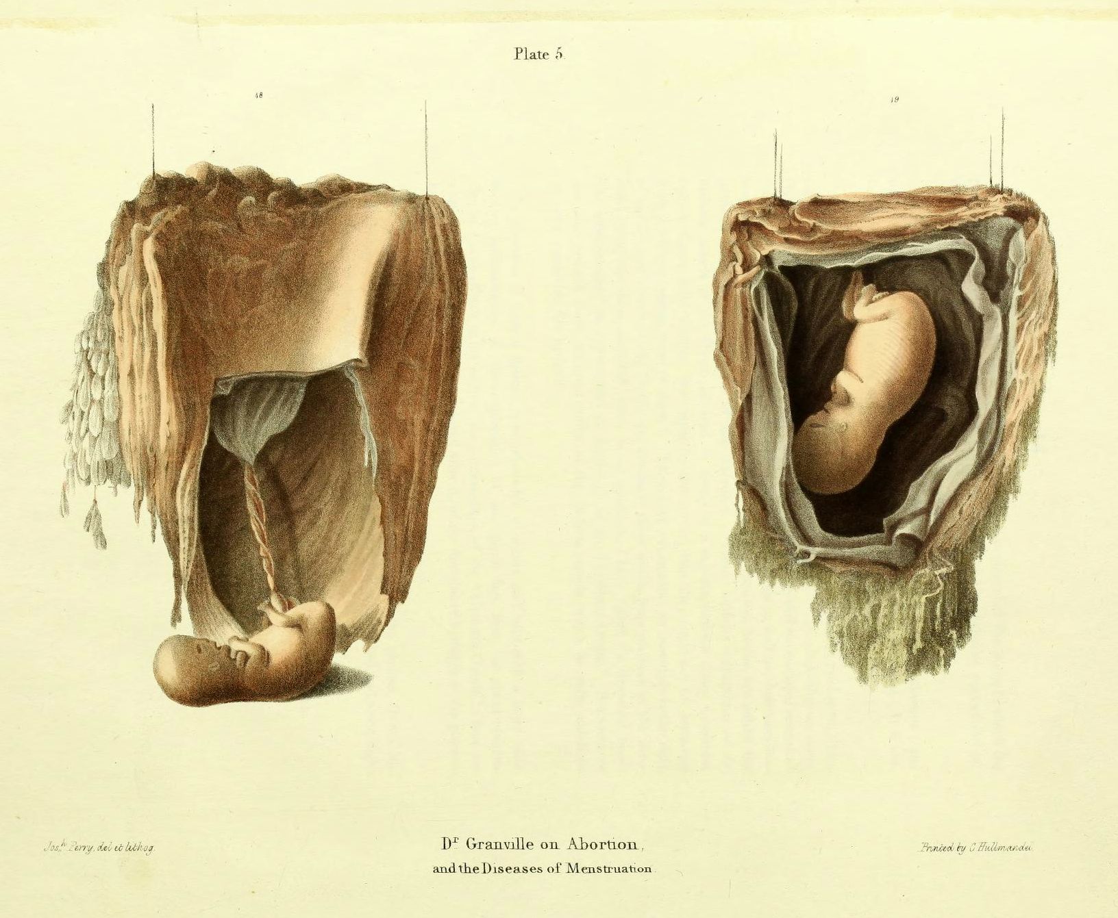 A vintage medical illustration depicting two views of a uterus containing a fetus, labeled as 'Plate 5' and related to Dr. Granville's work on abortion and menstrual diseases.