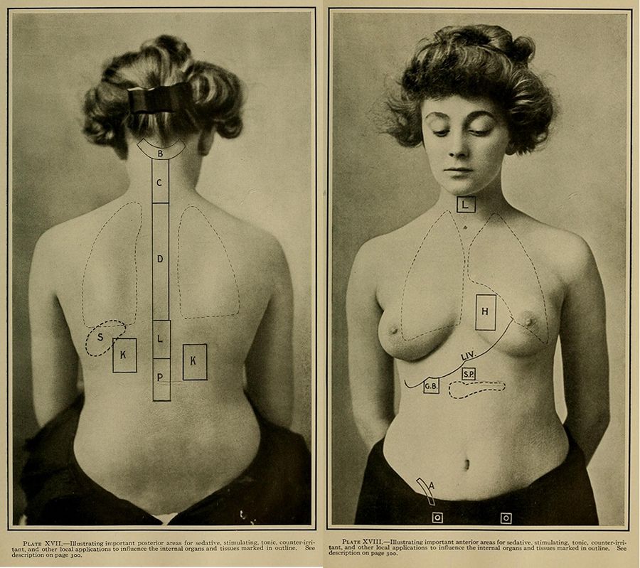 Vintage medical illustration of a woman's back and front views with anatomical markings.