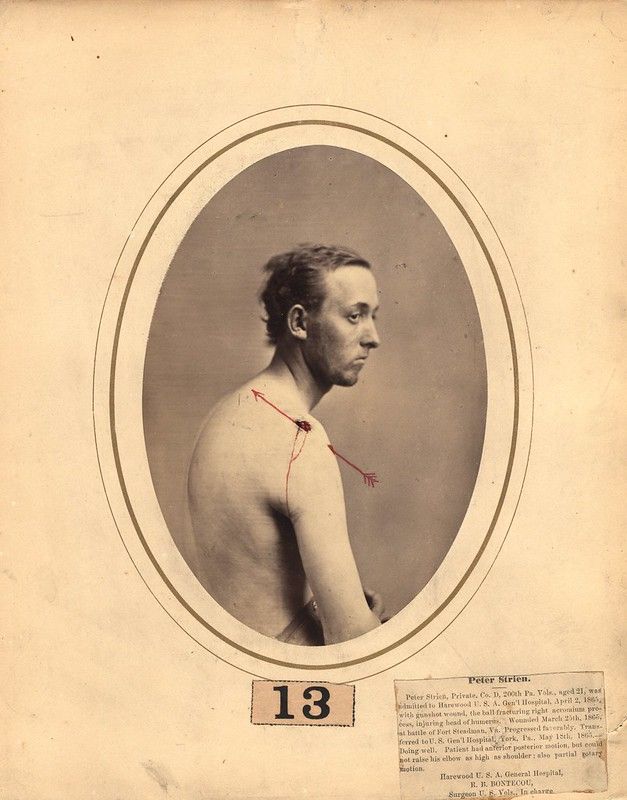 A vintage photograph of a man with a severe spinal deformity, likely a result of a war wound.