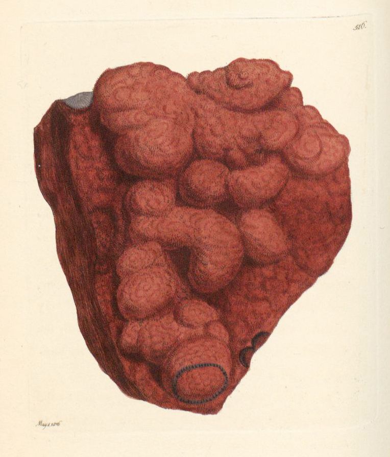 Vintage medical illustration of a diseased liver, rendered in reddish-brown with a bumpy texture.