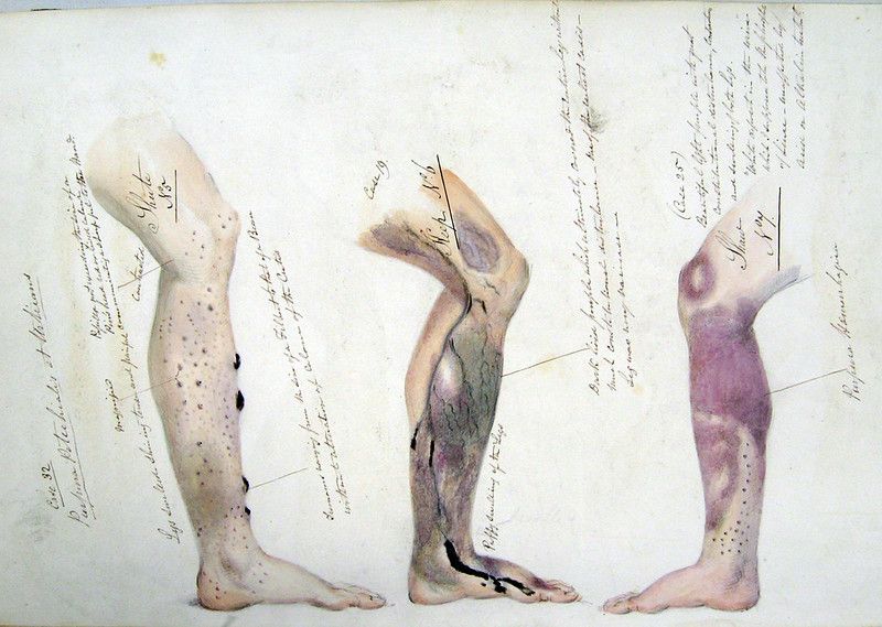 Vintage medical illustration of three legs with varying degrees of skin discoloration and spots.