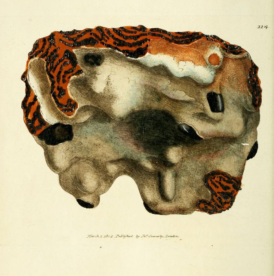 Vintage medical illustration of a conjoined head with two faces joined at the crown.