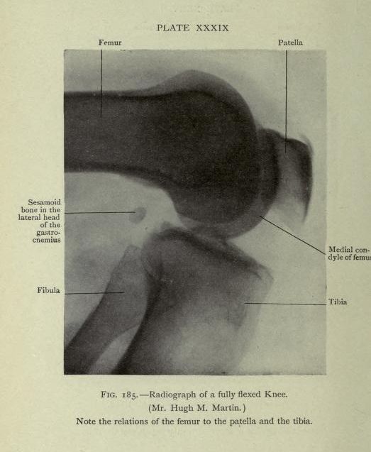 Vintage black and white radiograph of a fully flexed knee with labeled anatomical features.
