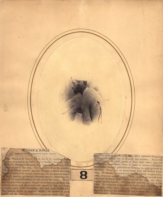 A sepia-toned photograph of a severe wound on a person's arm, surrounded by a circular pattern of damaged tissue and a block of historical medical text.