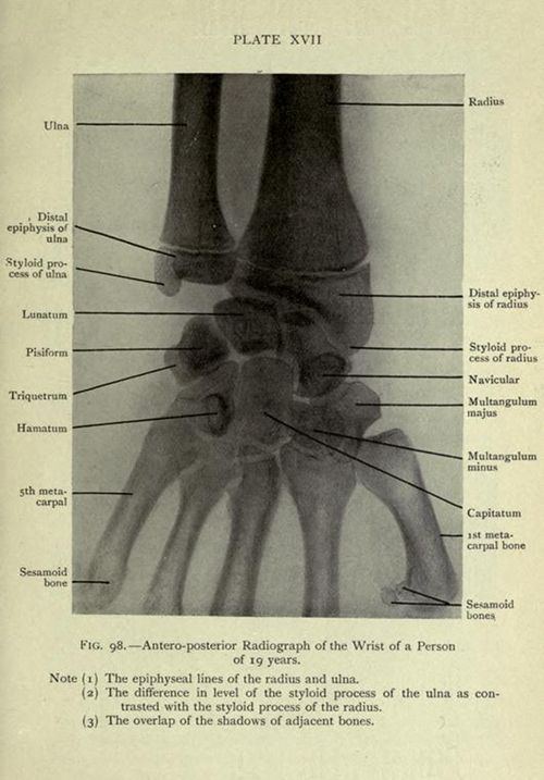Vintage radiograph of a human wrist with anatomical labels.