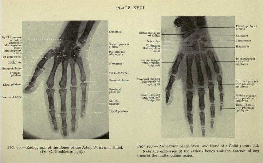 A medical illustration showing two radiographs of the hand and wrist, one of an adult and one of a 5-year-old child, with labels pointing to the various bones and growth plates.