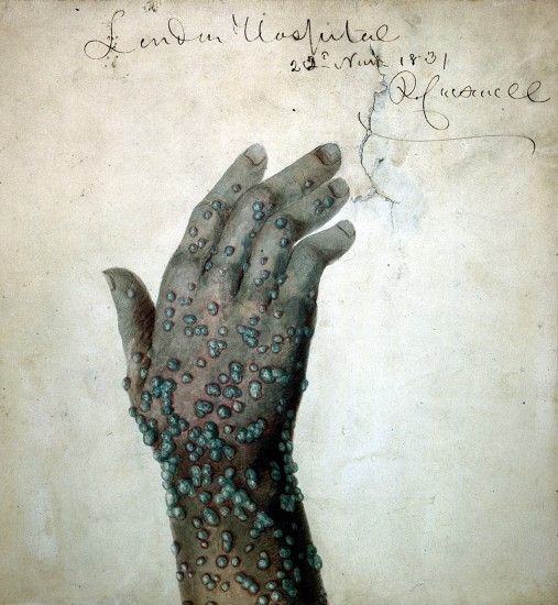 A vintage photograph of a hand covered in numerous, bright blue blisters.