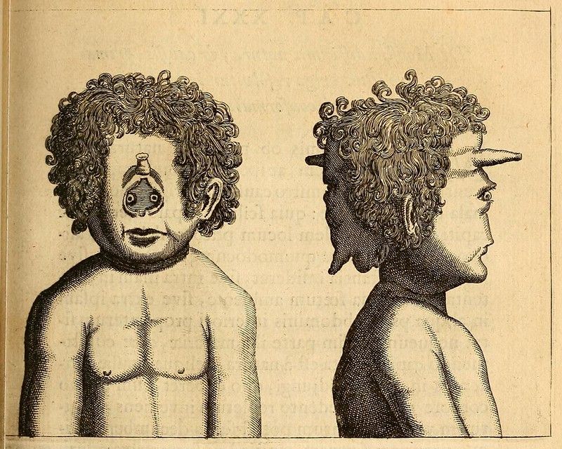 Vintage medical illustration of a person with a rare congenital condition, showing frontal and profile views.