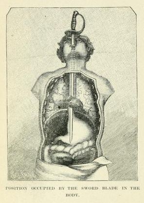 Vintage anatomical illustration of a human torso with a sword impaled through it.