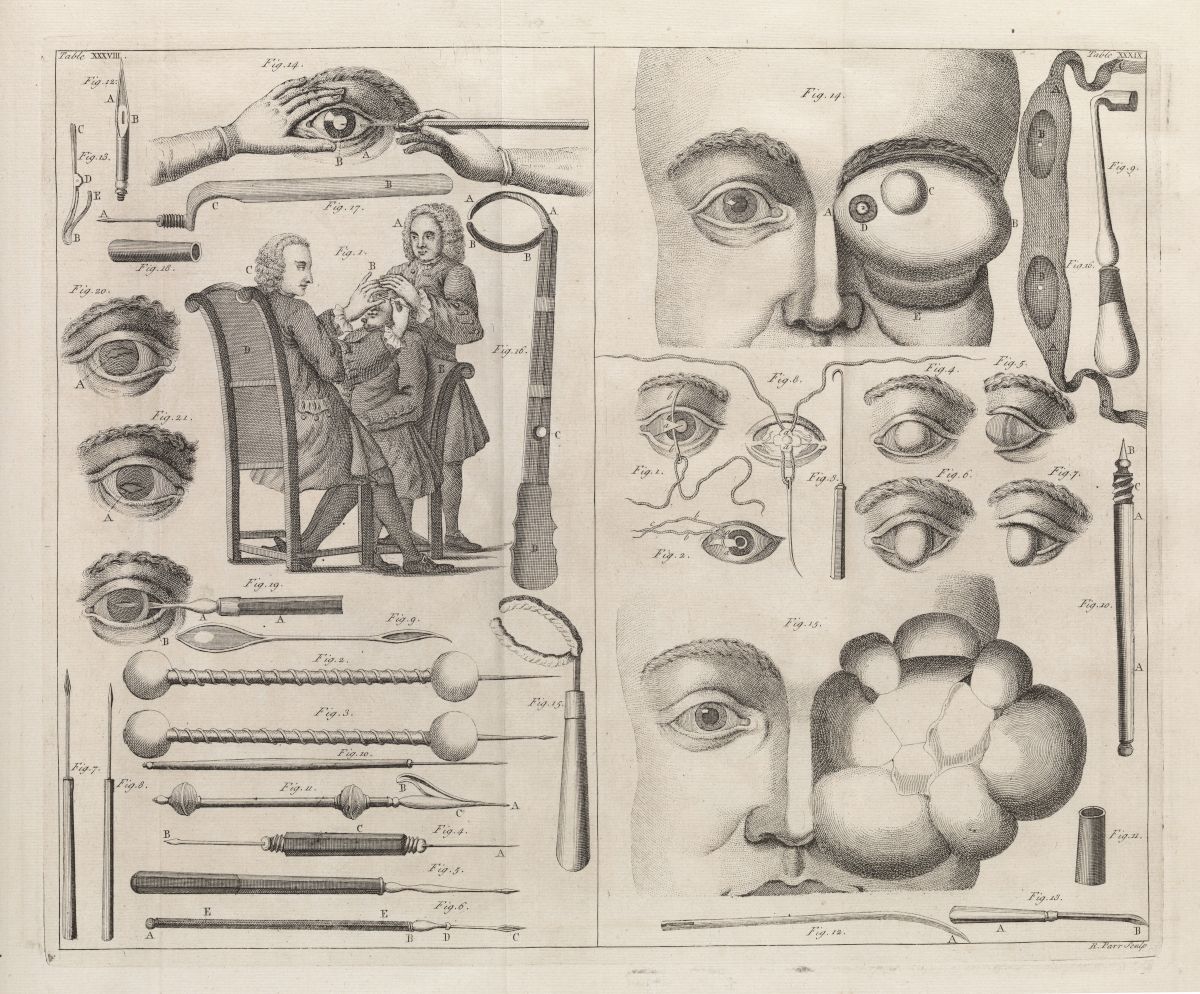 Antique anatomical engraving of eye surgery, featuring detailed illustrations of eyes, faces, and surgical instruments.