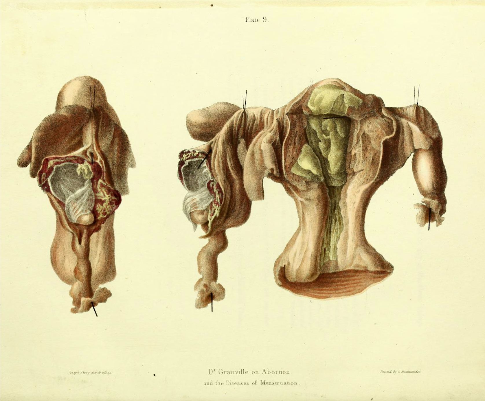 Vintage anatomical illustration of the female reproductive system, showing the uterus, fallopian tubes, and ovaries in detail.