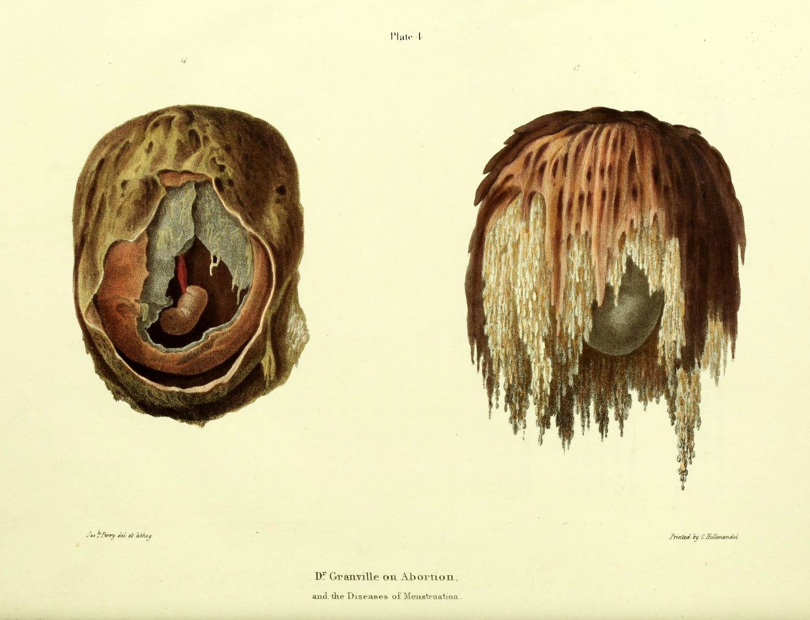 Vintage medical illustration of a uterus after an abortion, showing the uterine cavity, fetal form, blood, and tissue debris. Two views are presented, one with a more intact uterus and the other with significant tissue hanging down from the opening.