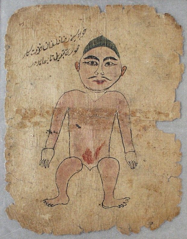 Vintage medical illustration of a person with a medical condition, drawn in a simple style on aged paper with Arabic or Persian text above.