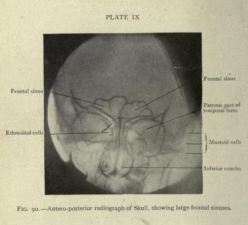 Black and white radiograph of a skull with labeled anatomical structures.
