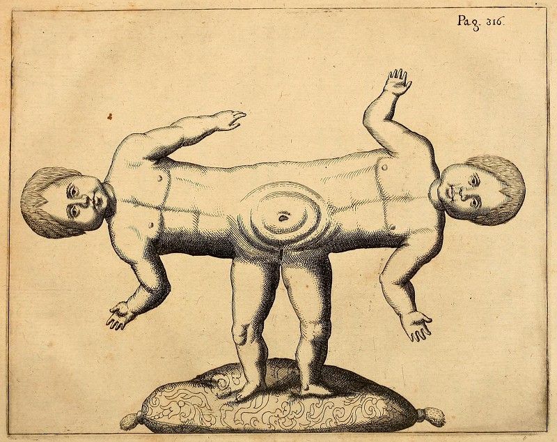 Historical medical illustration of conjoined twins joined at the abdomen, resting on a decorated pillow.