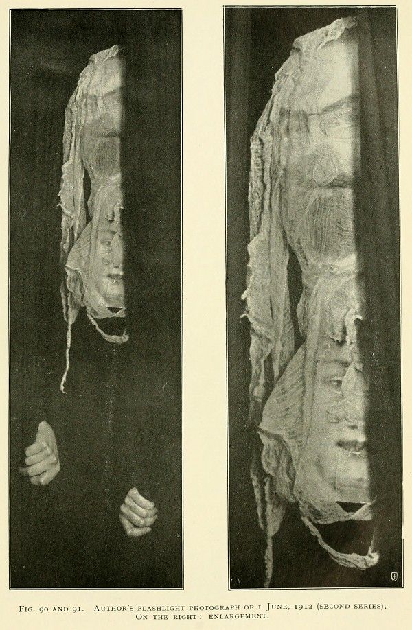 Two black and white photographs of a heavily bandaged arm and hand, showing torn and disintegrating bandages and patches of skin underneath.
