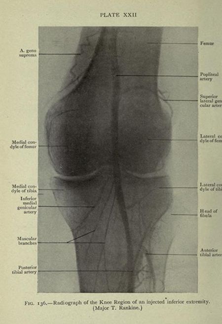 Vintage radiograph of a knee region with anatomical labels.