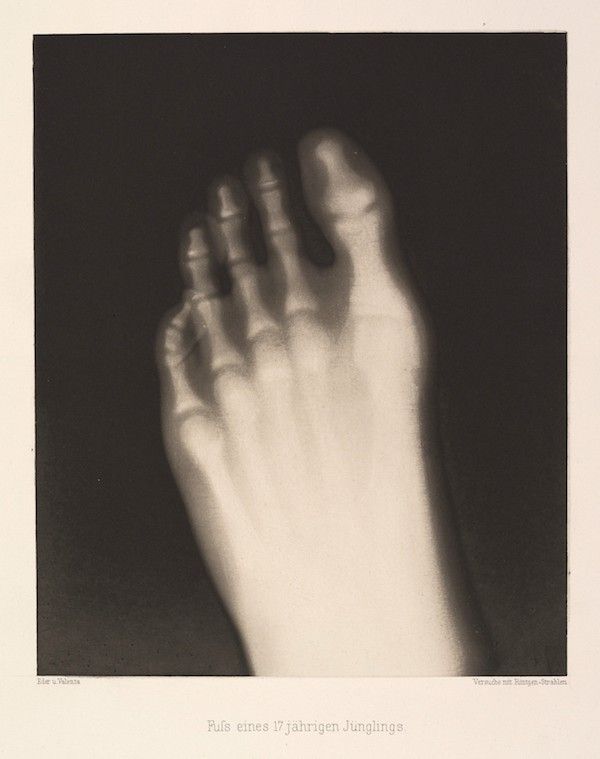 Vintage x-ray of a 17-year-old boy's foot and lower leg.