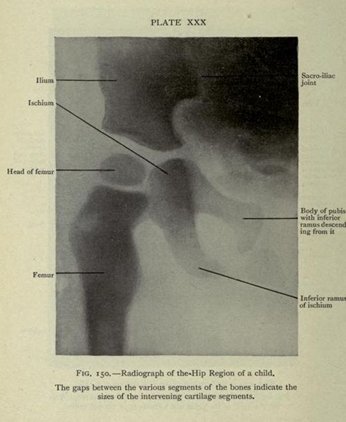 Vintage radiograph of a child's hip region with anatomical labels.
