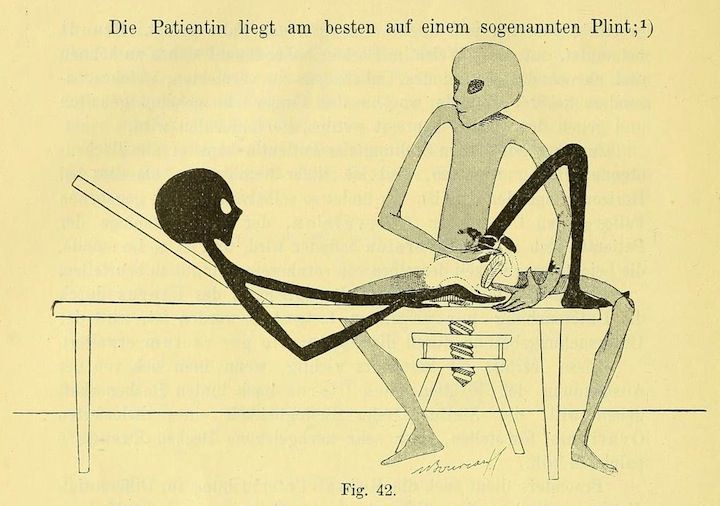 Vintage medical illustration of a doctor examining a very thin patient lying on a table.