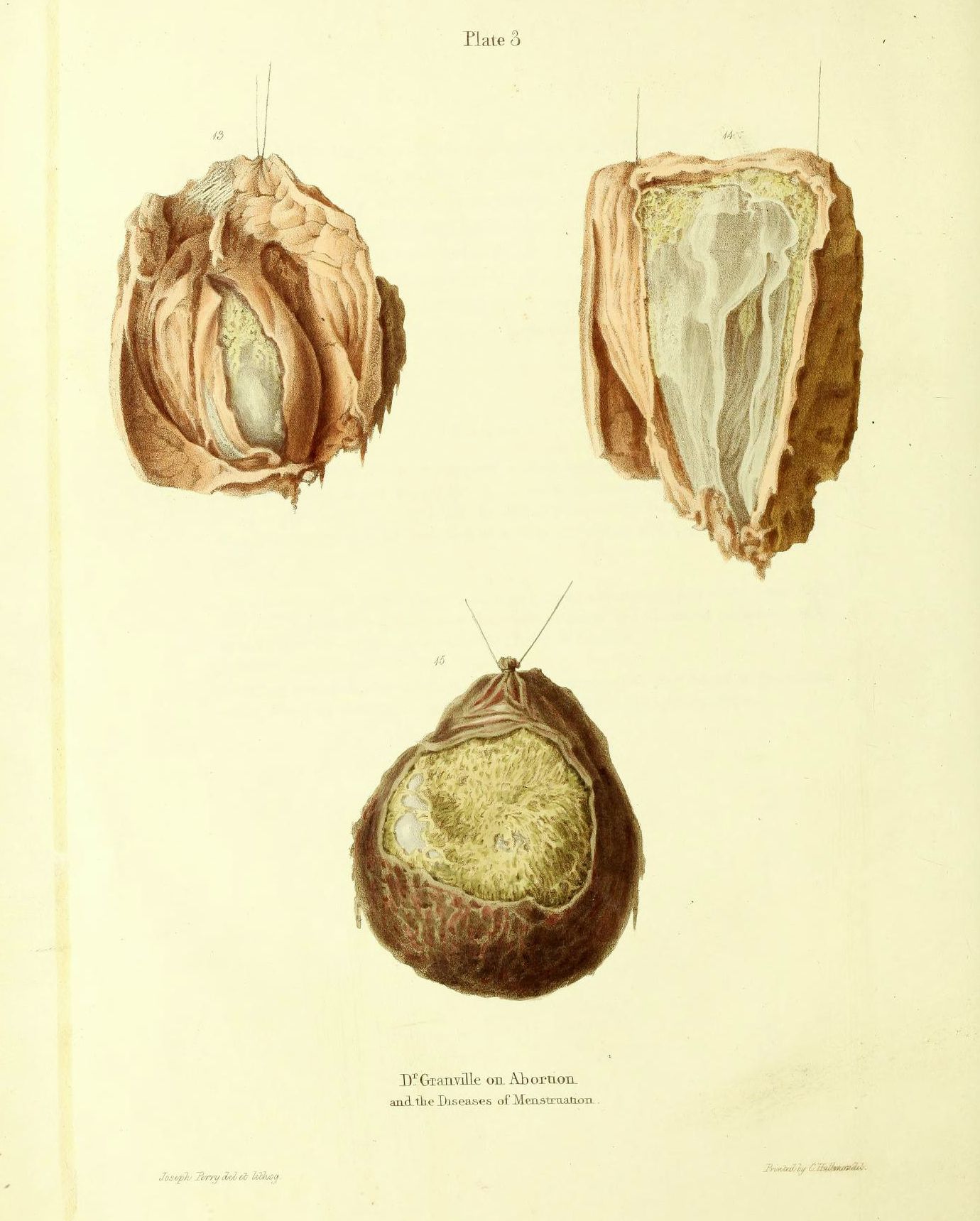 Vintage medical illustration of three dissected uteruses labeled 13, 14, and 15, titled "Plate 3" and "D'Granville on Abortion and the Diseases of Menstruation".
