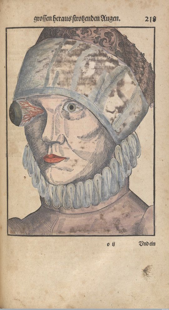 Vintage illustration of a person with a protruding eye, rendered in a detailed, cross-hatched style.
