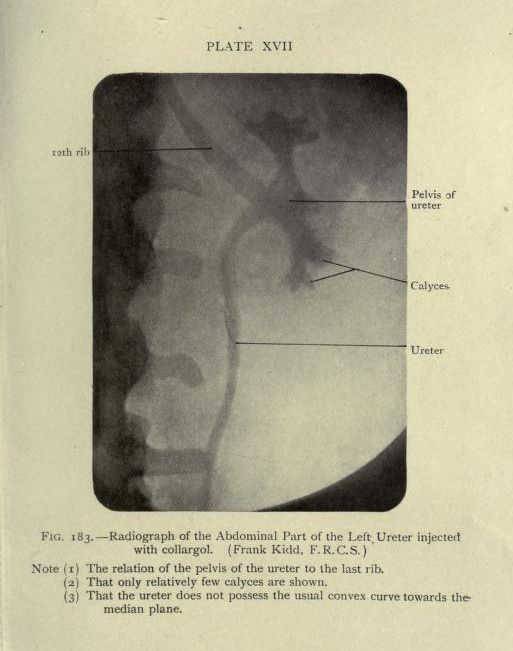 Vintage medical radiograph of the left ureter, labeled with anatomical features like the 12th rib, pelvis of the ureter, calyces, and the ureter itself.