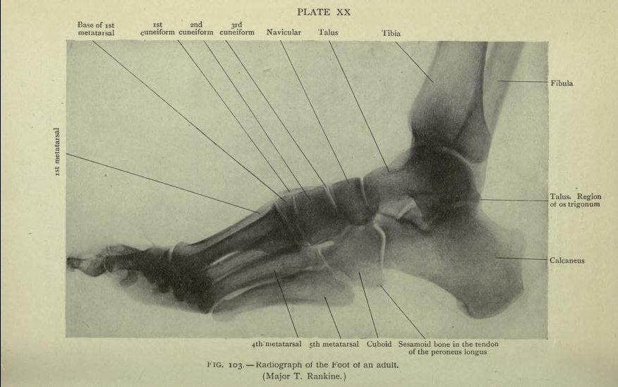 Black and white radiograph of an adult foot with labeled bones including tibia, fibula, talus, calcaneus, navicular, cuneiforms, and metatarsals.