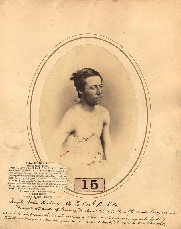 A historical photograph of a wounded soldier, John H. Bowers, taken in 1865. The photograph is presented within an oval frame, and the soldier is the central focus. He is shirtless, revealing extensive wounds on his back and chest, with visible blood. The soldier has short hair and appears to be in his early twenties. Below the photograph is a handwritten document detailing his case.