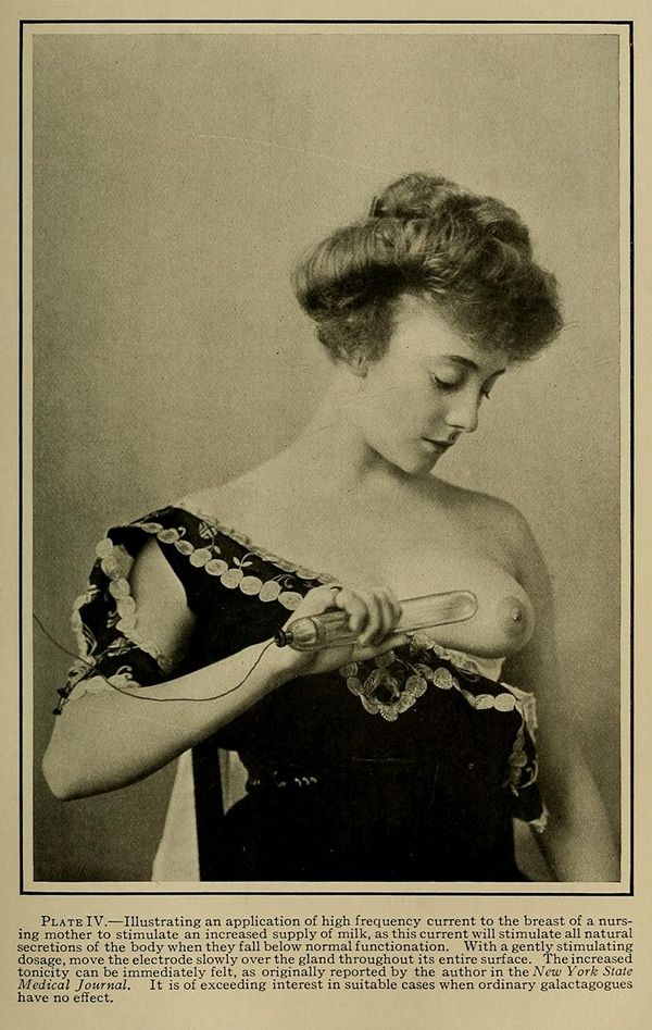 Vintage photograph of a woman undergoing a medical procedure involving the application of high-frequency current to her breast.