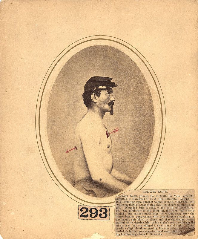 A sepia-toned portrait of a Civil War soldier named Ludwig Kohn, wearing a Union Army uniform and displaying a significant wound on his left shoulder and chest.
