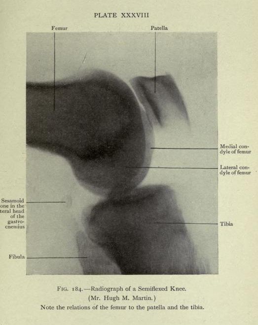 Vintage radiographic image of a semiflexed knee with labeled anatomical features.
