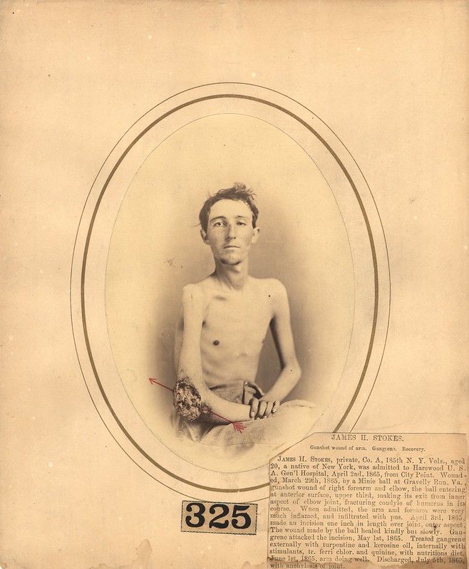 A vintage photograph of a young man in a military uniform with a heavily bandaged arm, presented in an oval frame. Text and a number are visible below the photograph.