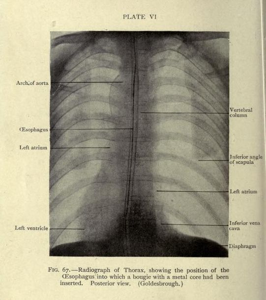 Vintage radiograph of a thorax with a bougie inserted into the esophagus.