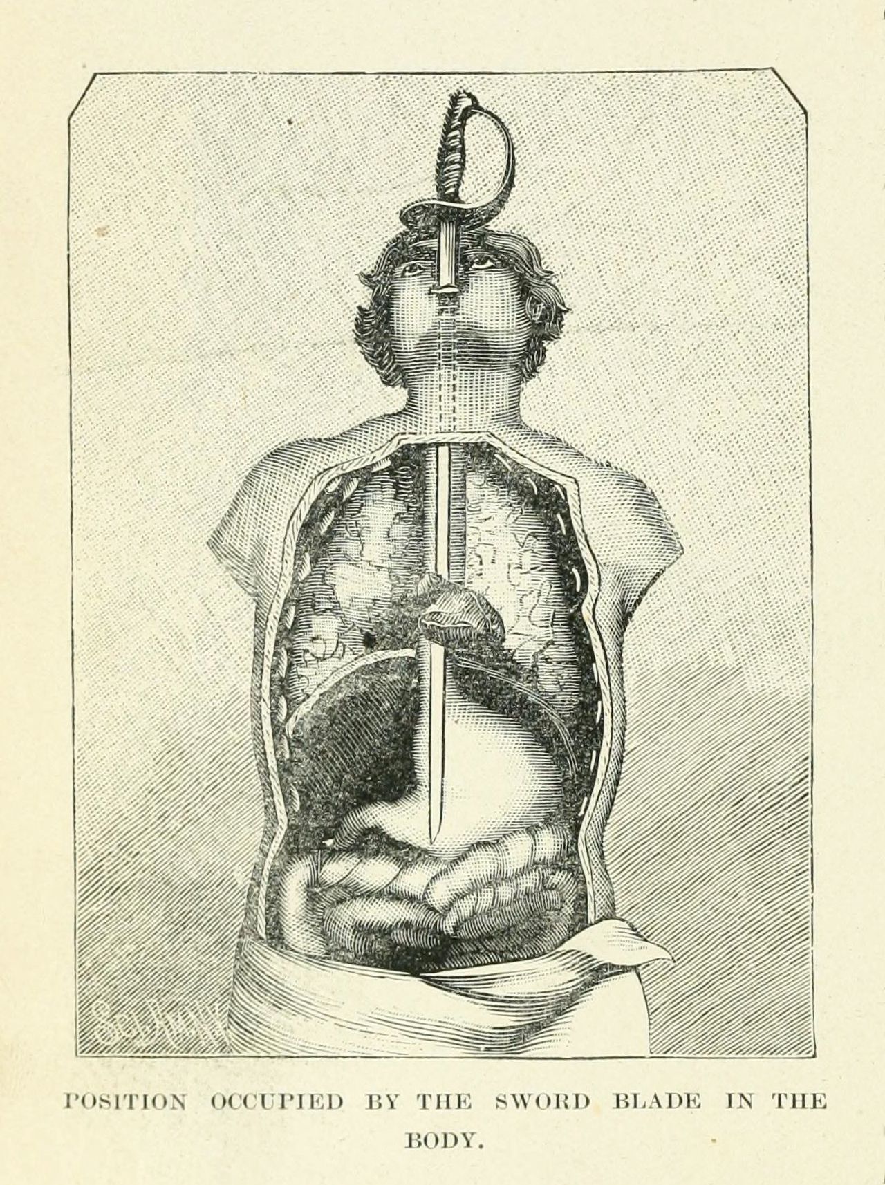 Vintage anatomical illustration of a human body with a sword penetrating through it.
