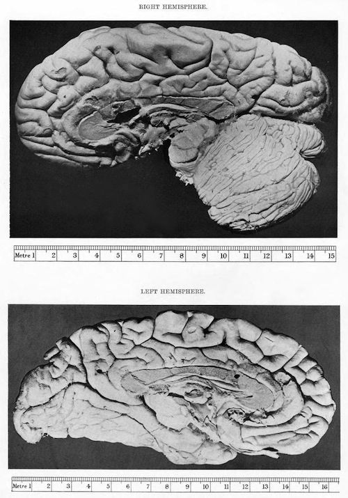 Vintage anatomical illustration of two brain hemispheres, labeled 'RIGHT HEMISPHERE' and 'LEFT HEMISPHERE', with scales for size reference.