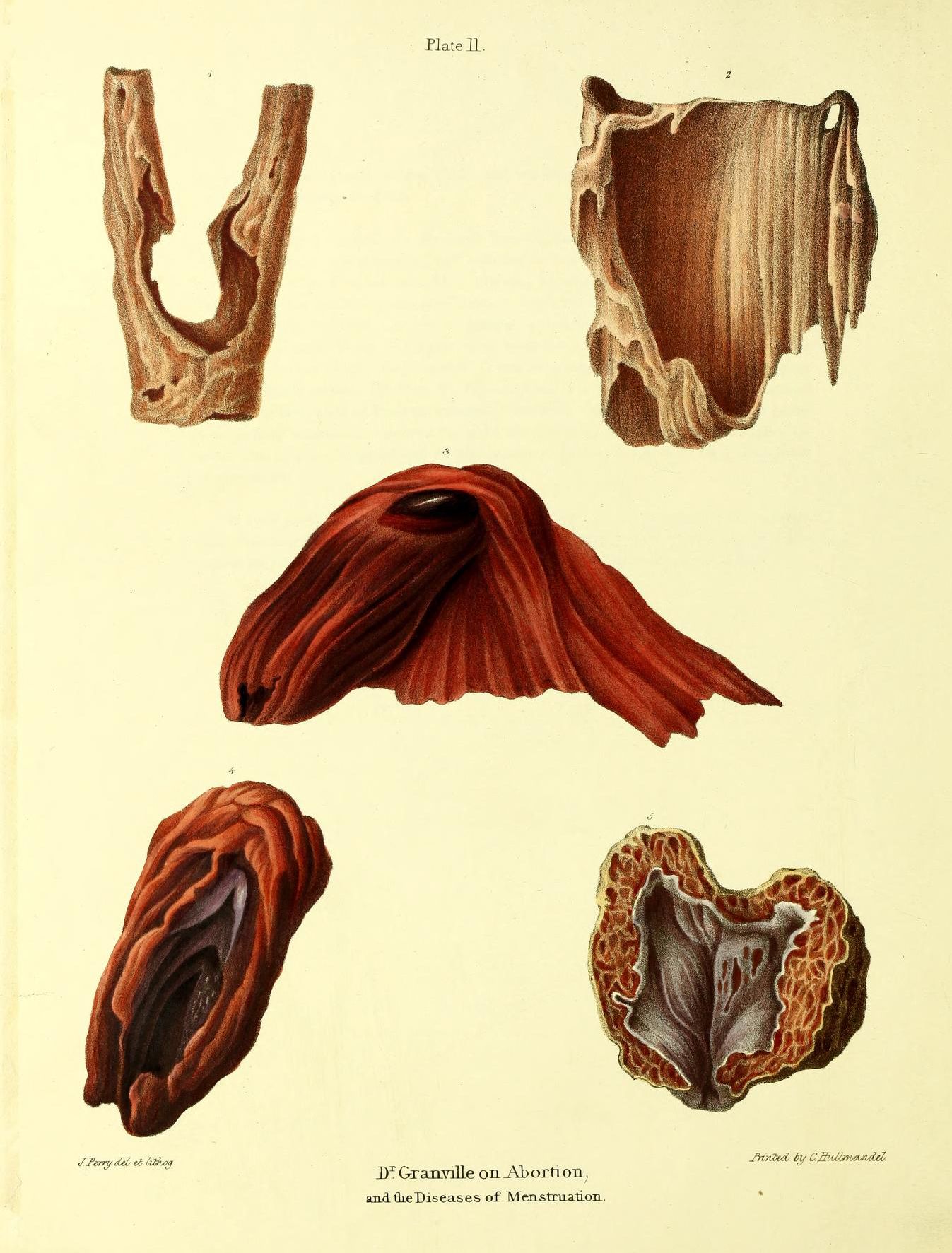 Vintage medical illustration of uterine tissue, labeled 'Plate II. Dr Granville on Abortion, and the Diseases of Menstruation.'