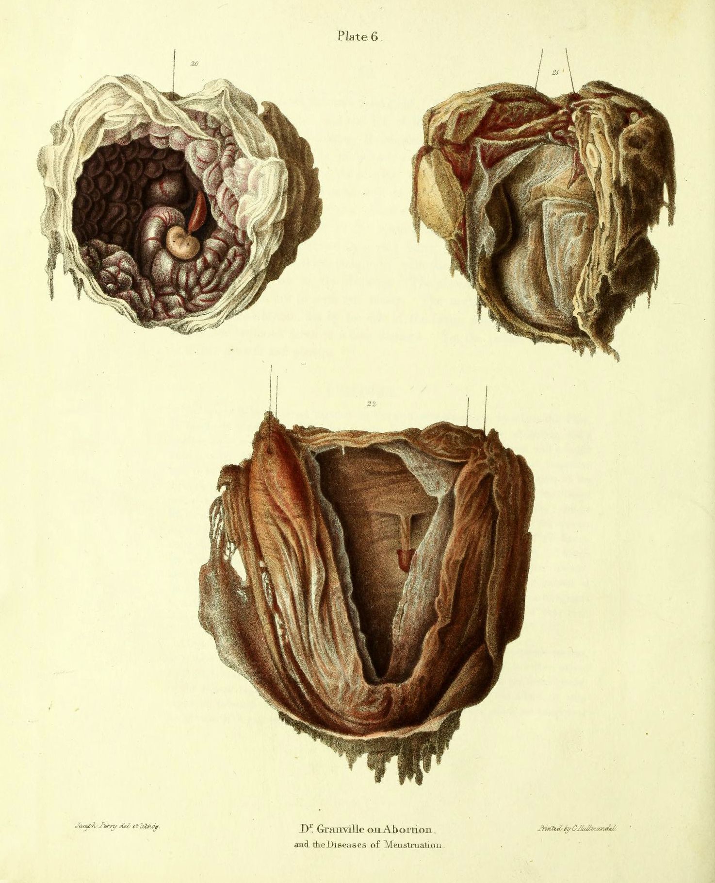 Vintage anatomical illustration of a uterus with a fetus inside.