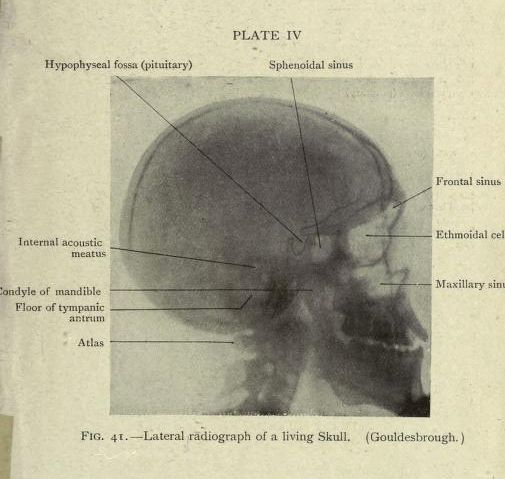 Vintage black and white radiograph of a human skull in profile, labeled with anatomical features.