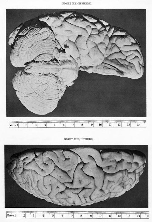 Two black and white photographs of the right hemisphere of a human brain, with a metric scale beneath each brain.