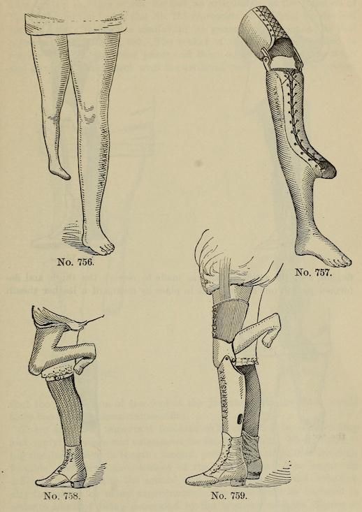 Vintage illustration of four different types of leg prostheses or supports.