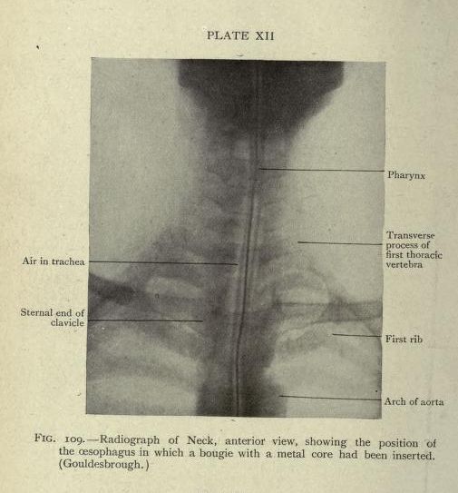 Vintage radiographic image of the neck, showing a bougie with a metal core inserted into the esophagus.