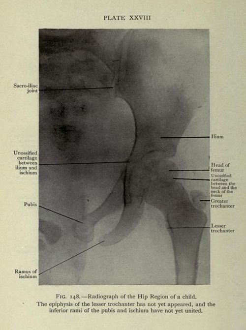 Vintage radiograph of a child's hip region with anatomical labels.